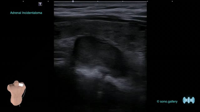 Parathyroid Adenoma, Incidentaloma