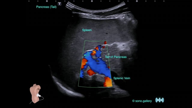 Pancreas (Tail)