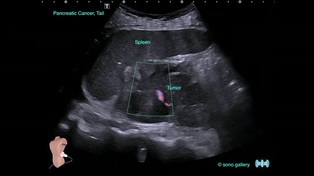 Pancreatic Cancer, Tail