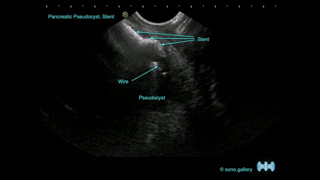 Pancreatic Pseudocyst, Stent