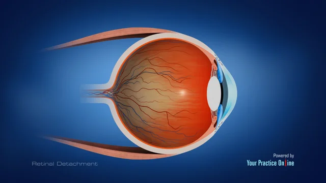 Retinal holes - All About Vision