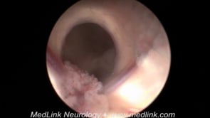 Treatment of intraventricular neurocysticercosis