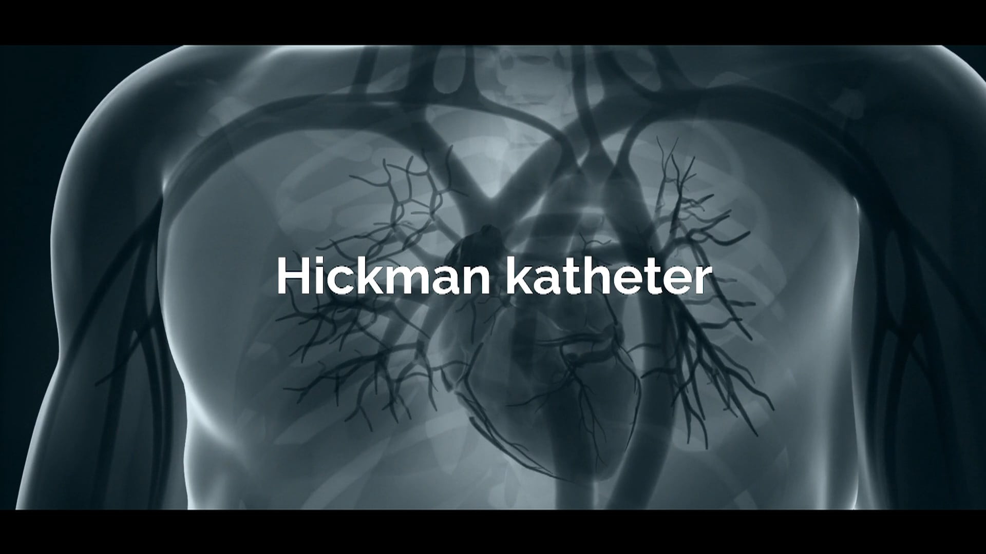 Hickman katheter bij hemodialyse on Vimeo