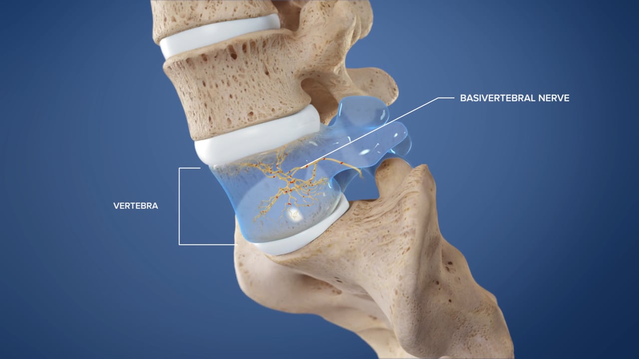 The Intracept Procedure - Patient Audience