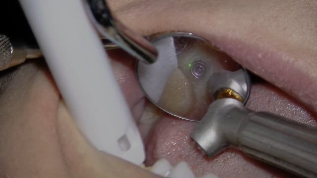 Solea Implant Uncovery #14 - Dr. Michael Kelly