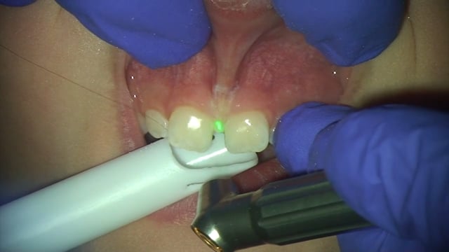 Solea Labial Frenectomy - Dr. Lawrence Kotlow