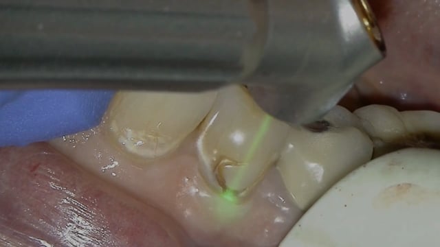 Solea Class V #22 Subgingival - Dr. Jeffrey Rohde