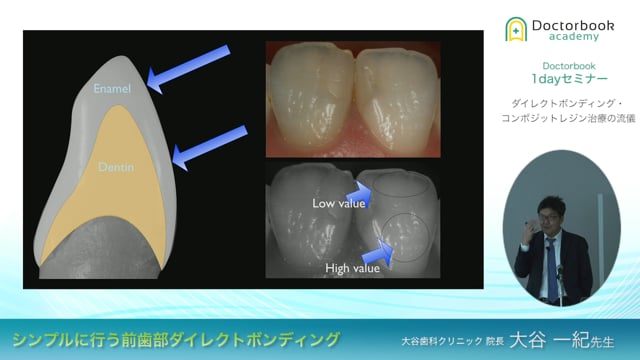 シンプルに行う前歯部ダイレクトボンディング | Doctorbook academy 