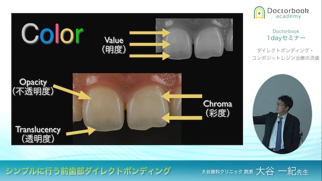 シンプルに行う前歯部ダイレクトボンディング | Doctorbook academy