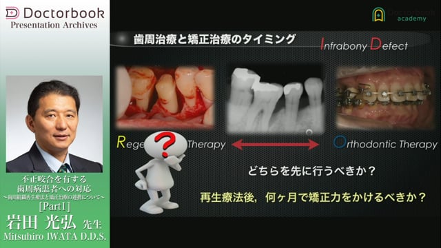 不正咬合を有する歯周病患者への対応 〜歯周組織再生療法と矯正治療の連携について〜