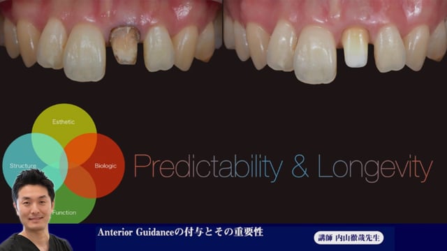 ⑭Anterior guidanceの付与とその重要性