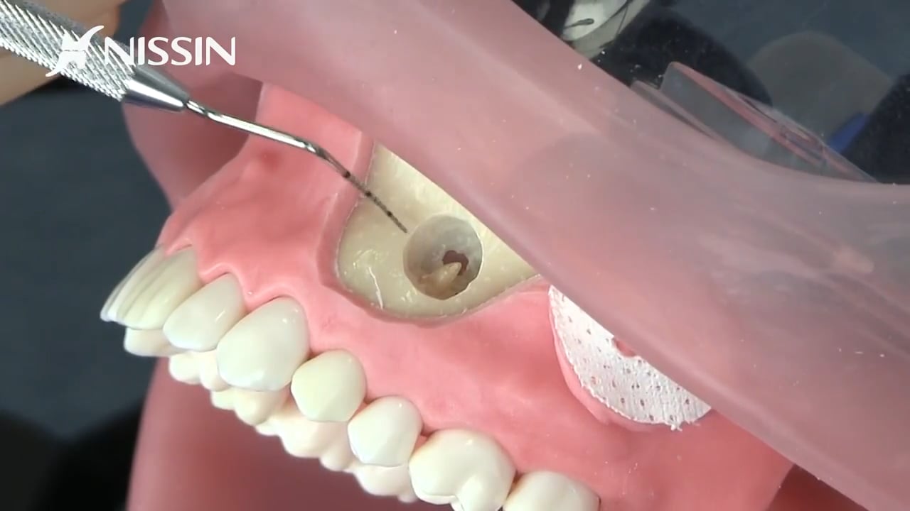 第5章 歯根端切除術の基本：歯根端切除術（上顎小臼歯）