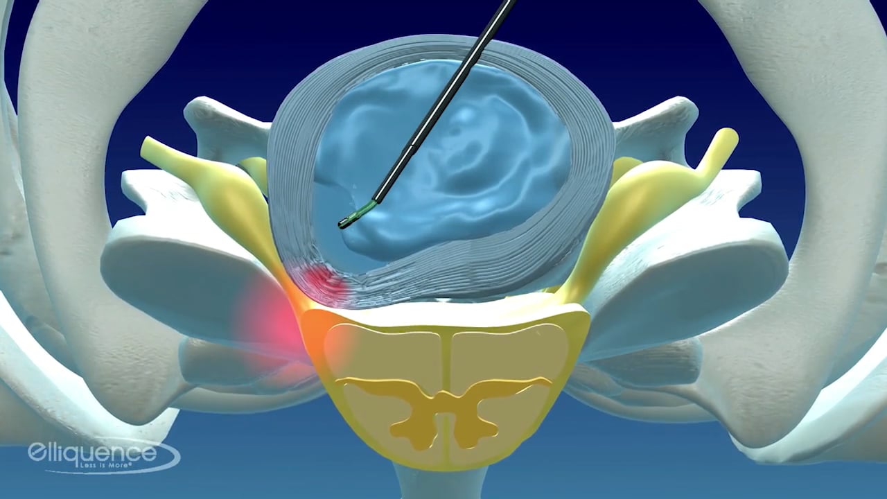 DiscFX Mini Animation on Vimeo