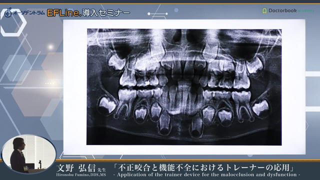 #10 萌出中の前歯部永久歯の対応