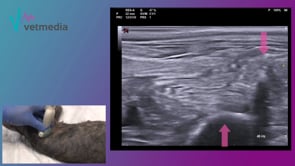 Bloqueo plexo lumbar ecoguiado