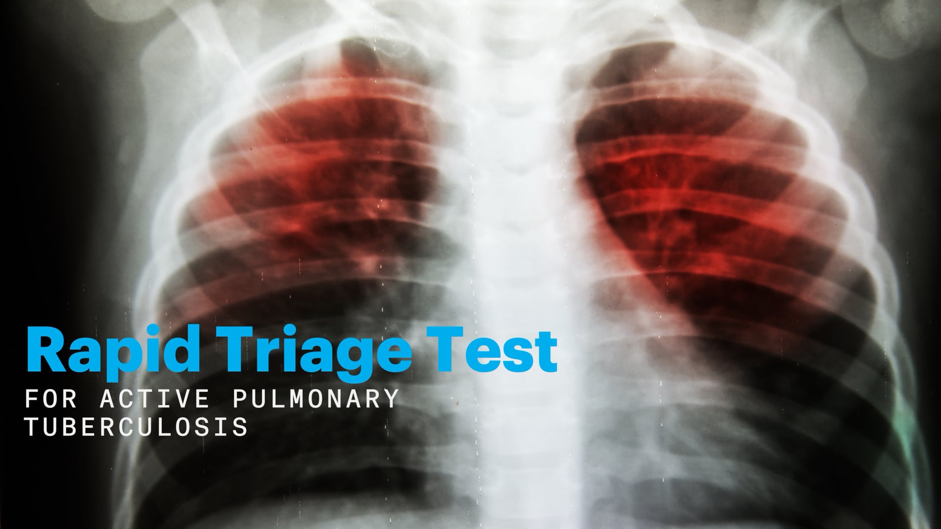 Rapid Triage Test for Active Pulmonary Tuberculosis