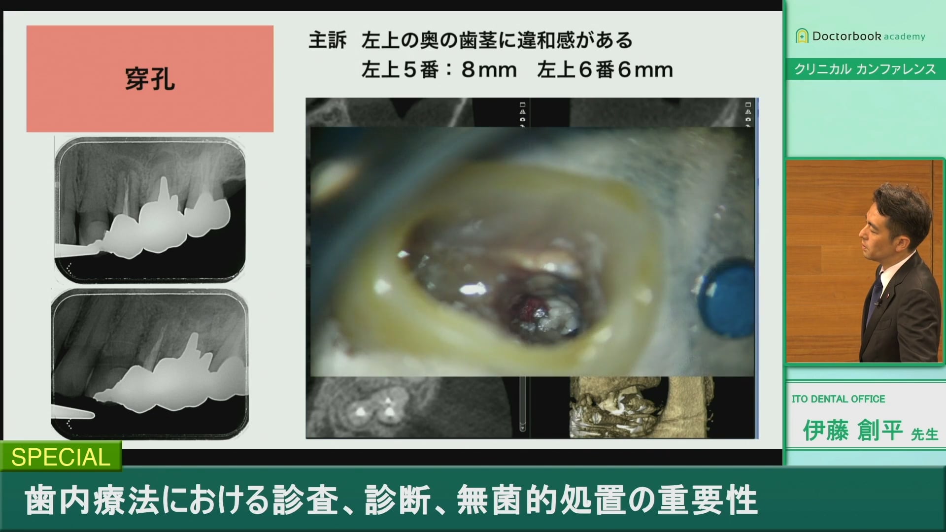 #3 根尖周囲組織の診査診断