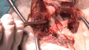 Estabilización vertebral lumbar (tornillos-cemento)