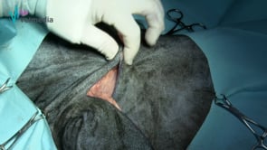 Colgajo omocervical de patrón axial