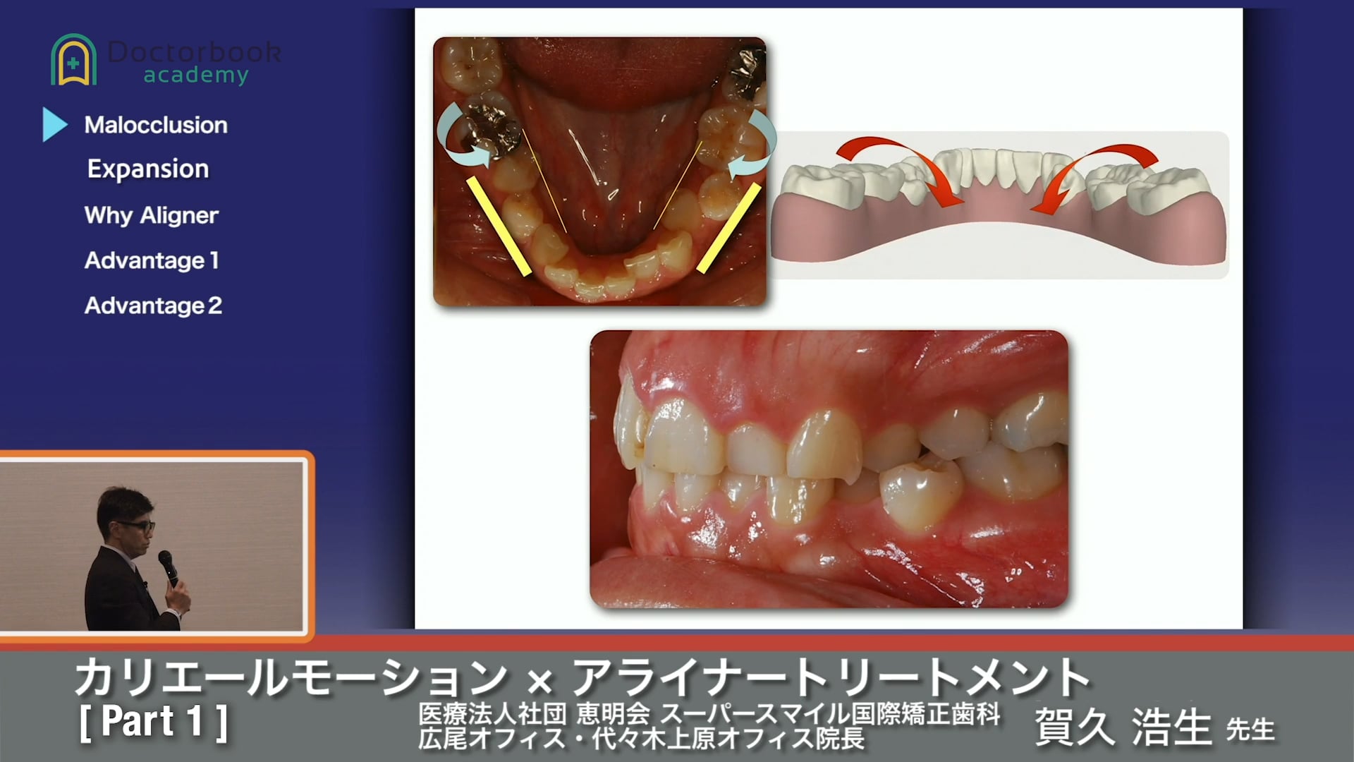 矯正歯科のトレンド ～カリエールモーション×アライナートリートメント～ #1