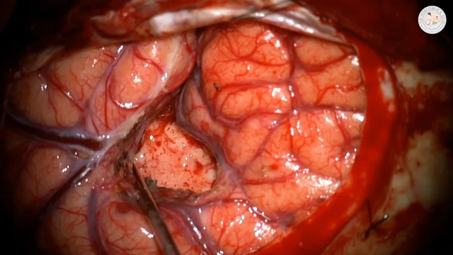 Frontal Insular Glioma