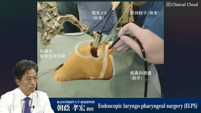 朝蔭 孝宏先生：ELPS（Endoscopic laryngo-pharyngeal surgery）