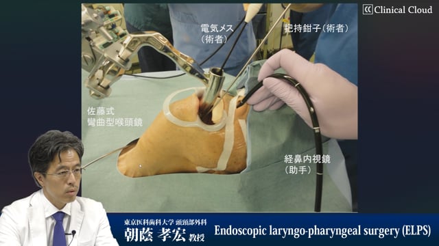 ELPS（Endoscopic laryngo-pharyngeal surgery）