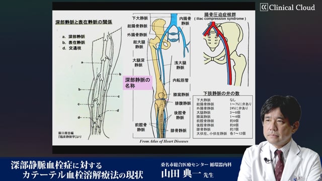 深部静脈血栓症に対するカテーテル血栓溶解療法の現状 Part1