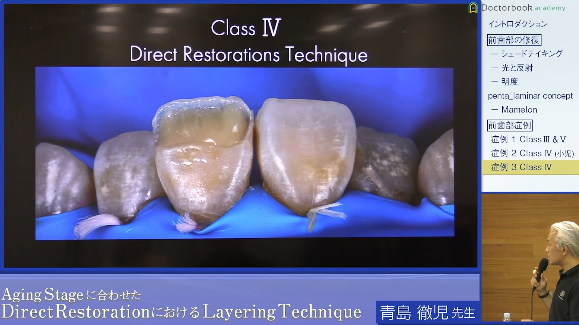 天然歯を模倣するダイレクトレストレーション テクニック #2