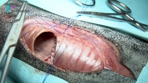 Traquectomía o técnica de resección y anastomosis traqueal