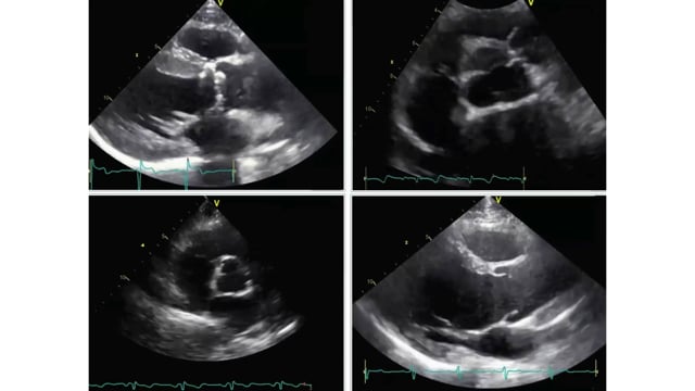 Can you tell if these aortic valves are stenotic?