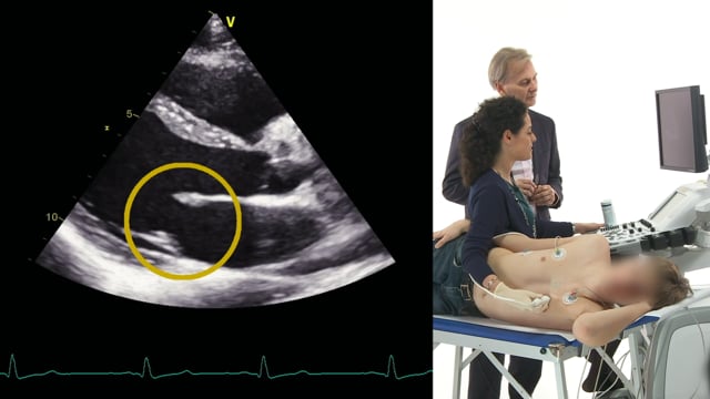 What does the mitral valve look like in echocardiography?