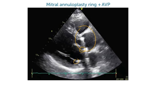 How do I identify mitral valve pathology on my echo image?