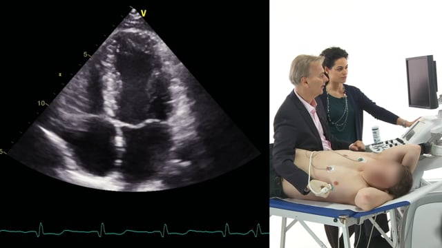 What views can I use for the assessment of the mitral valve?