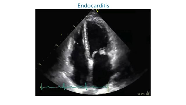 What does pathology look like on the mitral valve in the apical 4 chamber view?