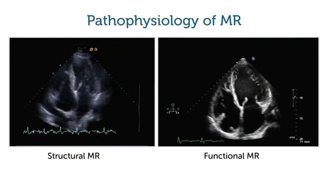 How do I know what is causing mitral regurgitation?