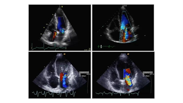 How do I grade mitral regurgitation without measurements?