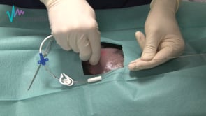 Tubo de toracostomía: técnica Seldinger