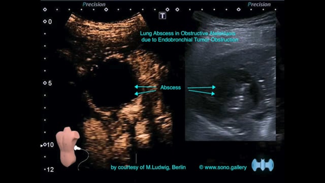 Lung Abscess in Obstructive Atelectasis