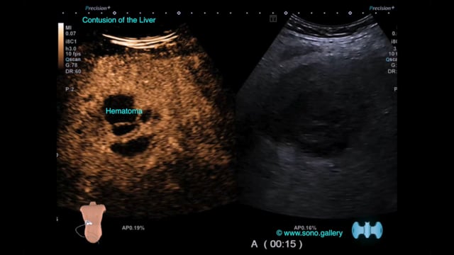 Contusion of the Liver