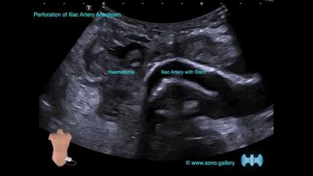 Perforation of Iliac Artery Aneurysm