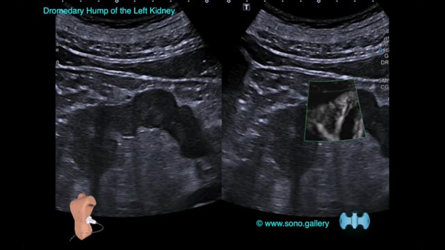 Dromedary Hump of the Left Kidney