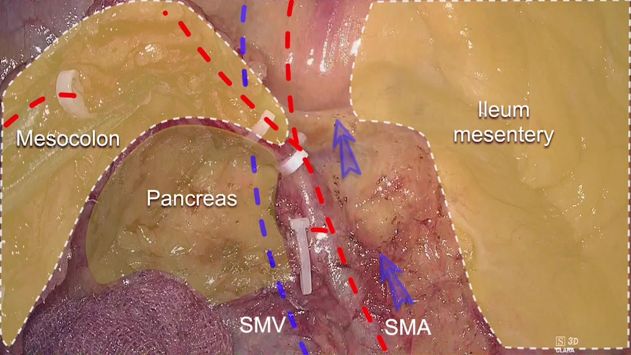 Excision of Extensive Recurrent Pilonidal Cyst with Gluteus Muscle Fascia  Plasty & Mid-line Closure 