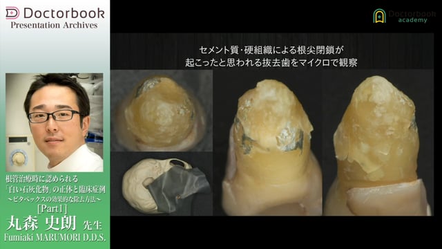 根管治療時に認められる「白い石灰化物」の正体と臨床症例 〜ビタペックスの効果的な除去方法〜