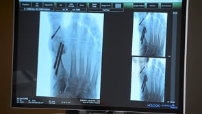 Akin Osteotomy and Final X-Ray with PECA System