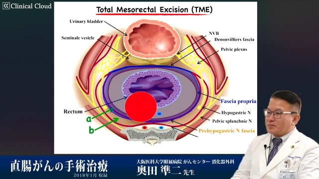 直腸がんの手術治療