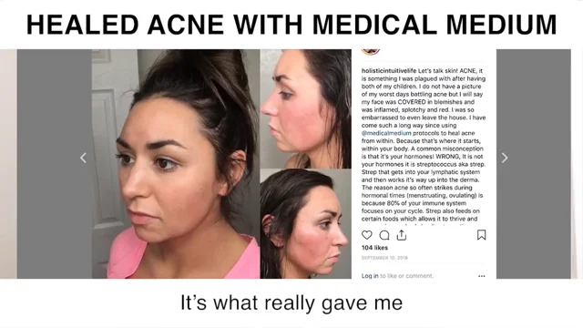 Medical medium outlet acne