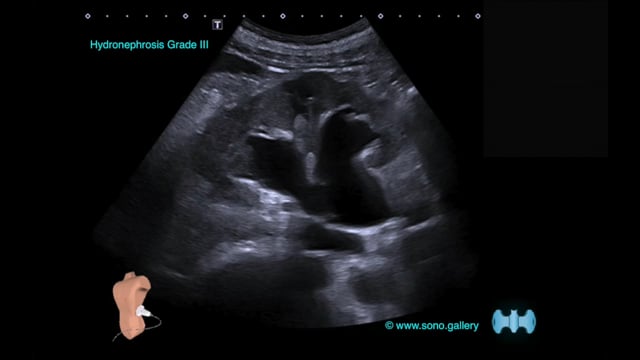 Hydronephrosis Grade III