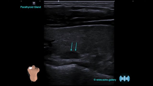 Parathyroid Gland