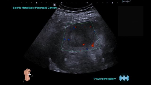 Splenic Metastasis (Pancreatic Cancer)